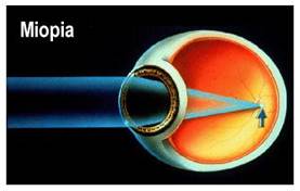 istoric medical în miopia oftalmologică